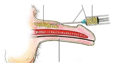 Surgical method of increasing the limb